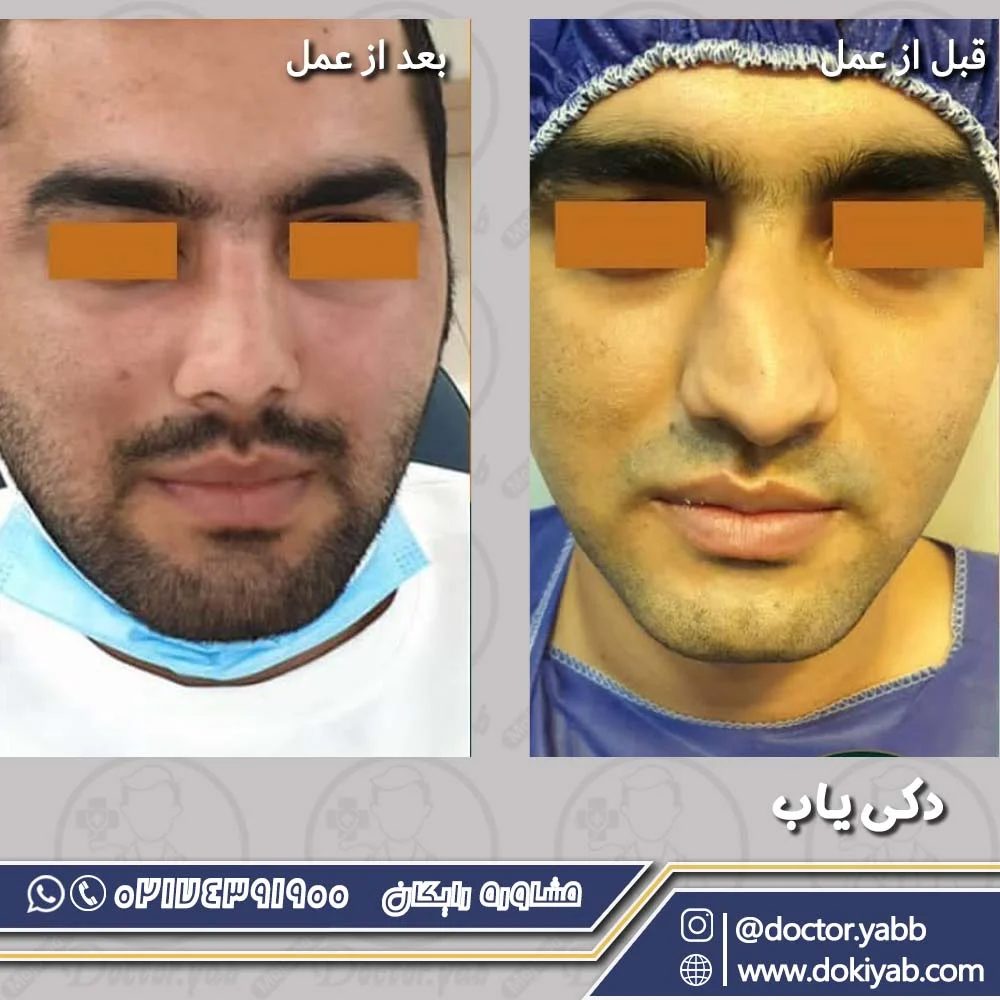 جراحی بینی گوشتی در شیراز، دکتر بهروز گندمی