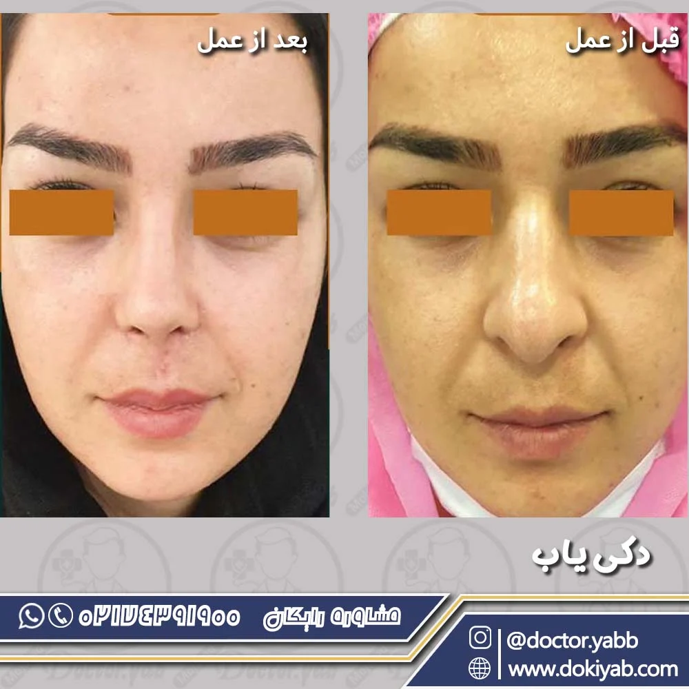 عمل بینی طبیعی در شیراز؛ دکتر بهروز گندمی