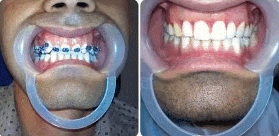 نمونه ارتودنسی دندان
