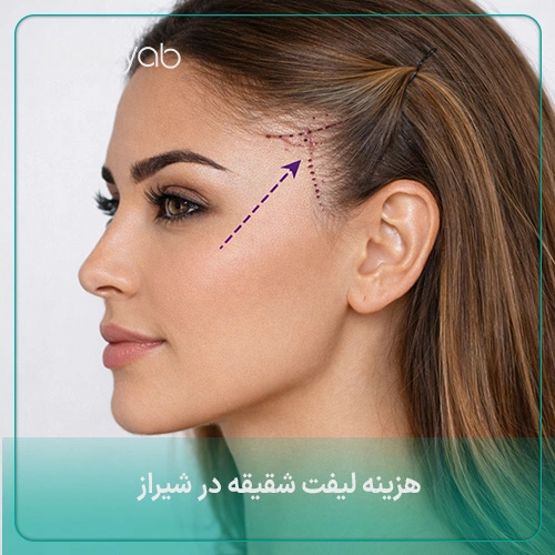 قیمت دقیق عمل لیفت شقیقه در شیراز