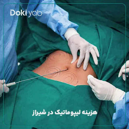 بررسی هزینه لیپوماتیک در شیراز در دکی یاب