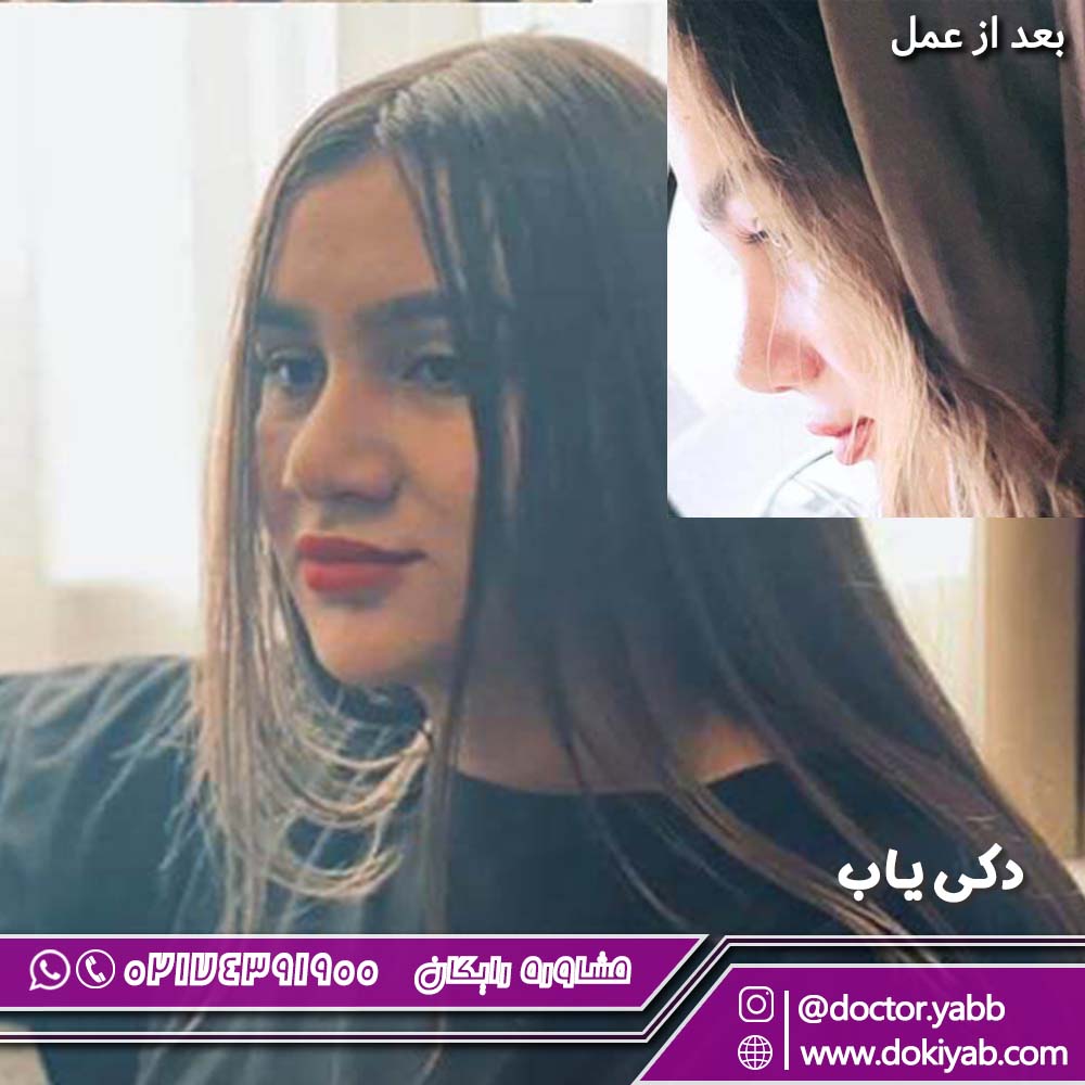 عکس قبل و بعد عمل بینی؛ دکتر غلامرضا معین جراح زیبایی بینی در شیراز
