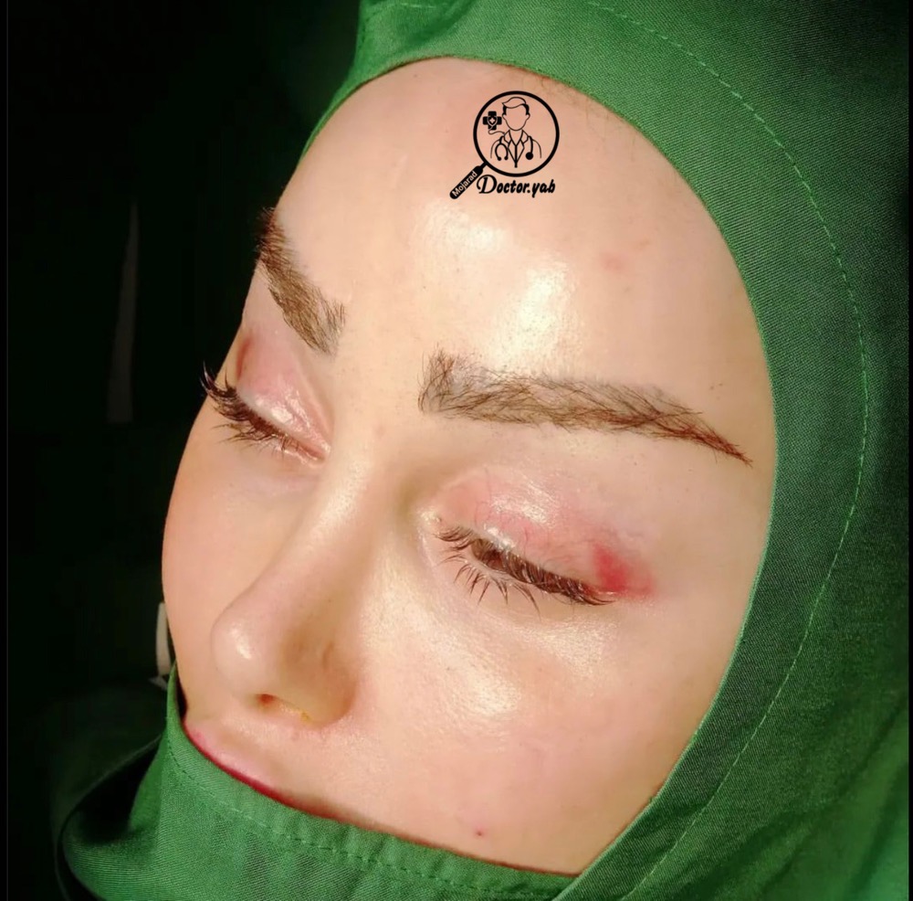 جراح لیفت پیشانی در شیراز