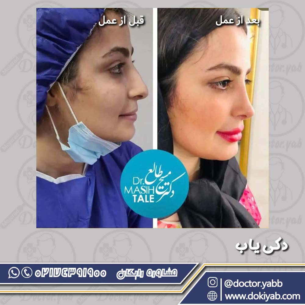 قبل و بعد از عمل جراحی بینی؛ دکتر مسیح طالع در شیراز