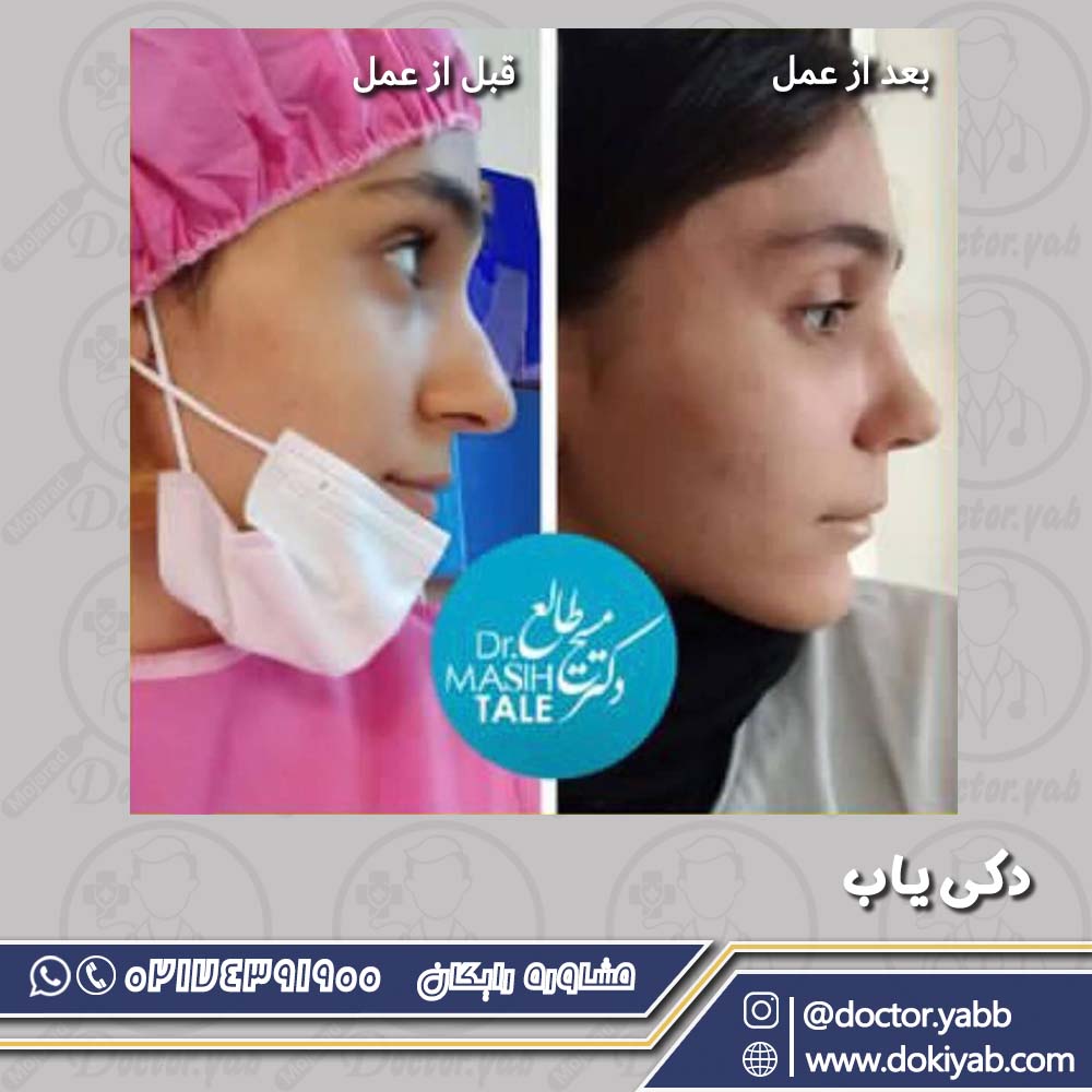 قبل و بعد عمل بینی؛ دکتر مسیح طالع در شیراز
