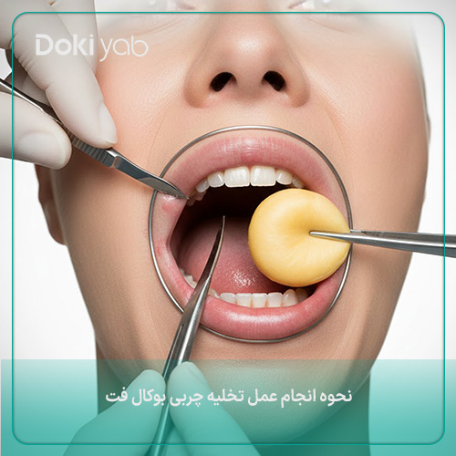 نحوه انجام عمل بوکال فت؛ مجموعه دکی یاب