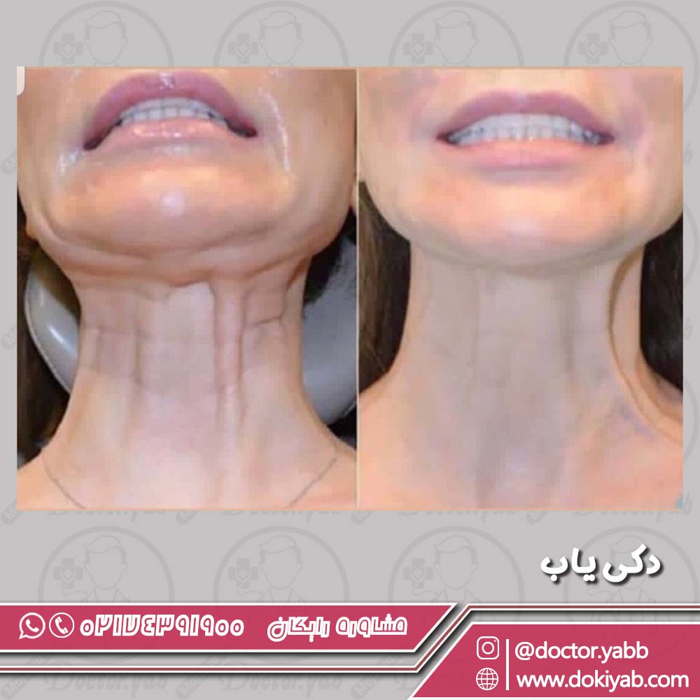 نمونه بوتاکس گردن چانه و دور لب با دکتر حیدر صفری در شیراز