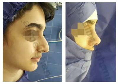 جراحی بینی استخوانی در تهران؛ دکتر میقانی