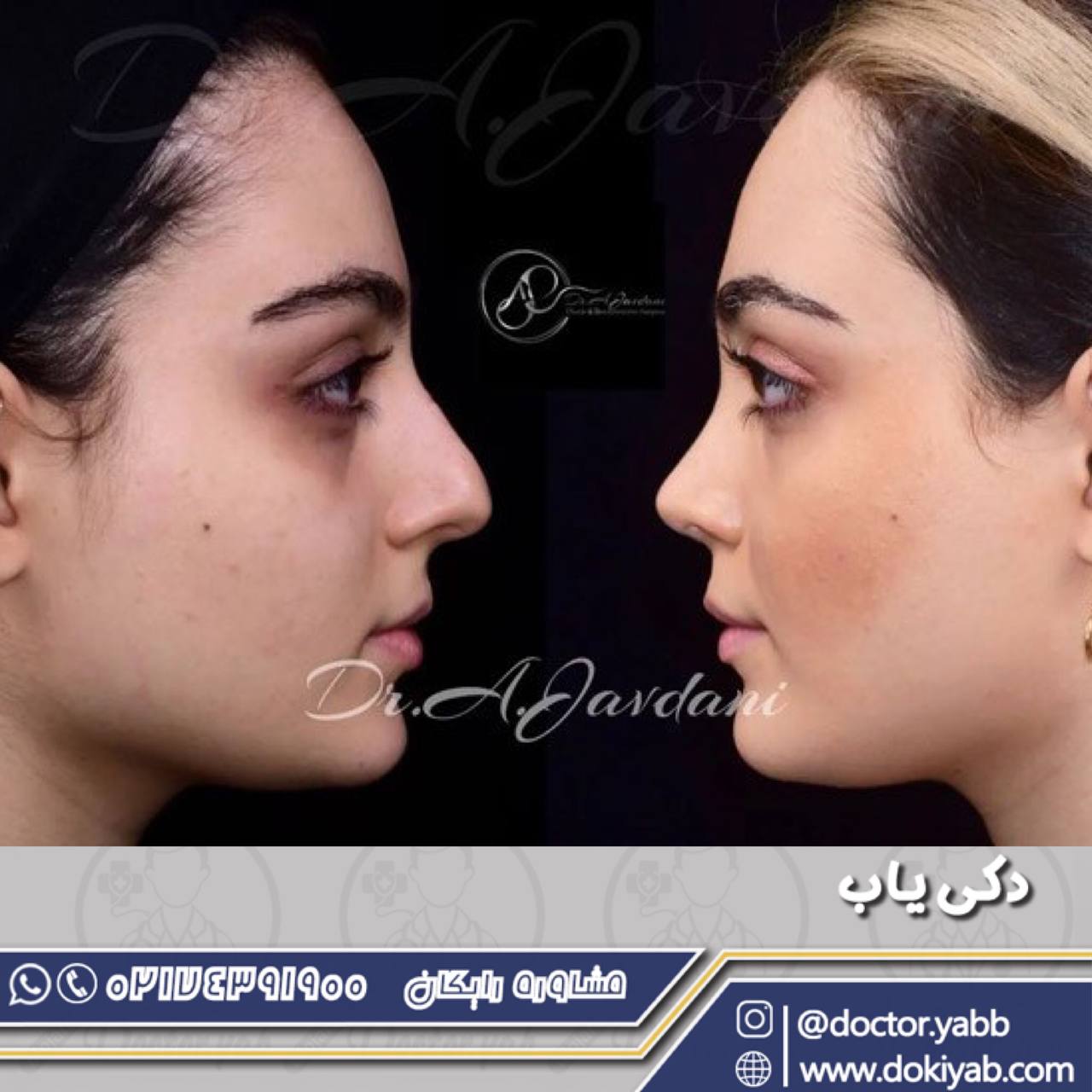 عمل بینی ارزان در سراسر ایران امکان پذیر شد تخفیف + شرایط اقساط