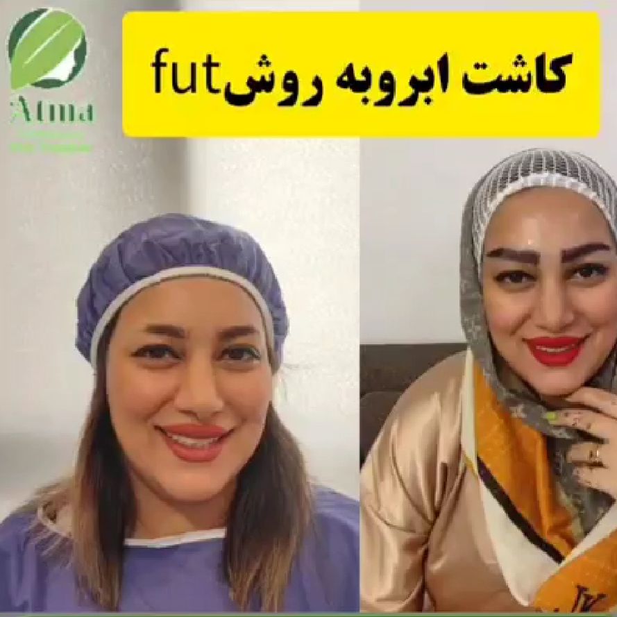 نمونه کاشت ابرو توسط تیم تخصصی کلینیک آتما؛ بهترین دکتر و کلینیک کاشت ابرو در شیراز