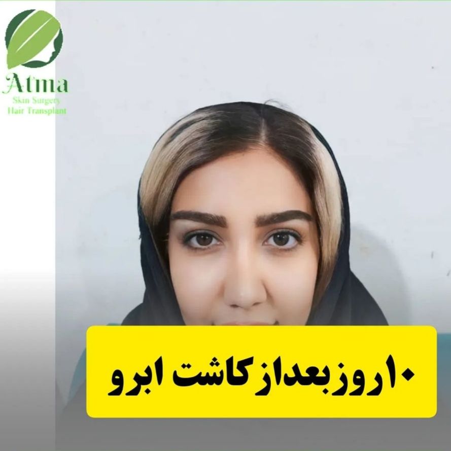 نمونه کار کاشت ابرو کلینیک آتما؛ بهترین دکتر و کلینیک کاشت ابرو در شیراز