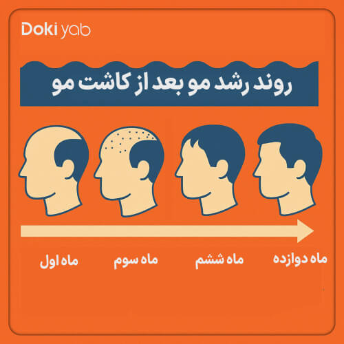 روند رشد مو بعد از کاشت در شیراز از ماه اول تا دوازدهم 