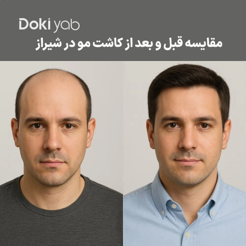 عکس قبل و بعد از کاشت مو در شیراز با نتایج طبیعی و پرپشت