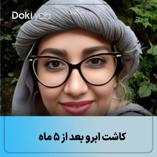 نمونه کار واقعی کاشت ابرو طبیعی در شیراز توسط کلینیک آتما با تکنیک FUE