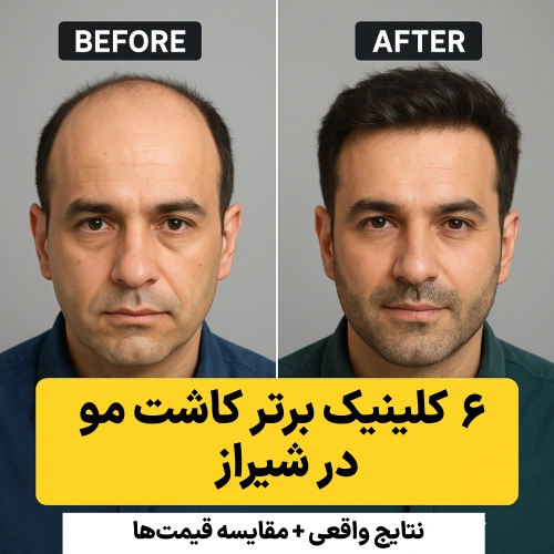 مقایسه تصویری قبل و بعد کاشت مو در شیراز؛ نتایج واقعی بیماران از ۶ کلینیک برتر سال ۲۰۲۵ با روش_های FIT، FUE و SUT