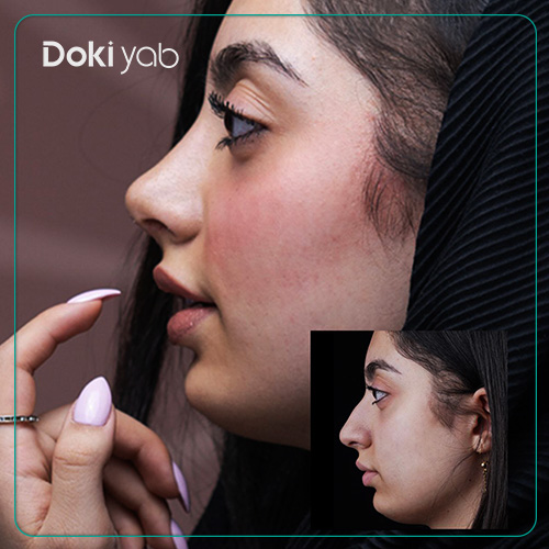 روش‌های مختلف عمل بینی ترمیمی؛ باز و بسته؛ نمونه عمل بینی با مشاوره مجموعه دکی یاب