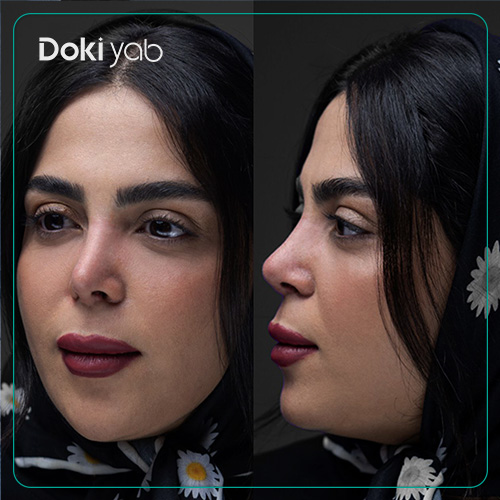 بررسی این‌که ترمیم بینی برای چه افرادی مناسب نیست؛ نمونه جراحی بینی با مشاوره دکی یاب