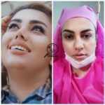 بهترین جراح بینی گوشتی در شیراز |نمونه کارهای جذاب+ نظرات +هزینه(1402)