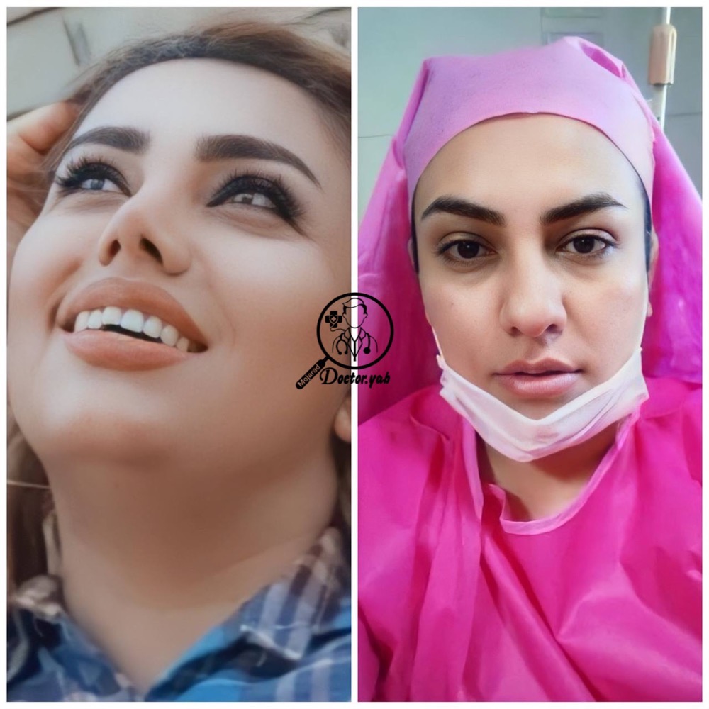 بهترین جراح بینی گوشتی در شیراز