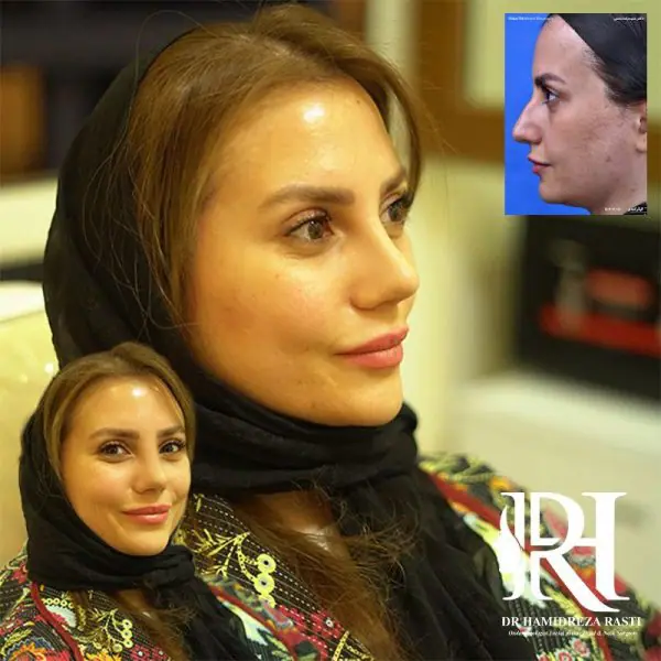 نمونه کار دکتر حمیدرضا راستی جراح بینی در تهران