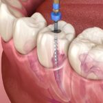 راهنمای جامع انتخاب بهترین دندانپزشک شیراز برای عصب کشی