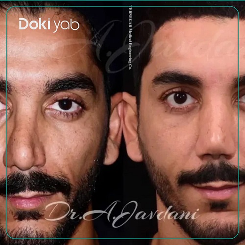 نمونه عمل بینی دکتر علی جاودانی جراح بینی ترمیمی در تهران