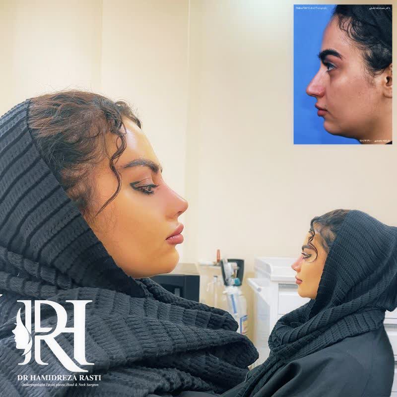 نمونه عمل بینی دکتر حمیدرضا راستی جراح بینی تهران