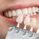هزینه کامپوزیت دندان در شیراز: چگونه می‌توانیم هزینه را کاهش دهیم؟