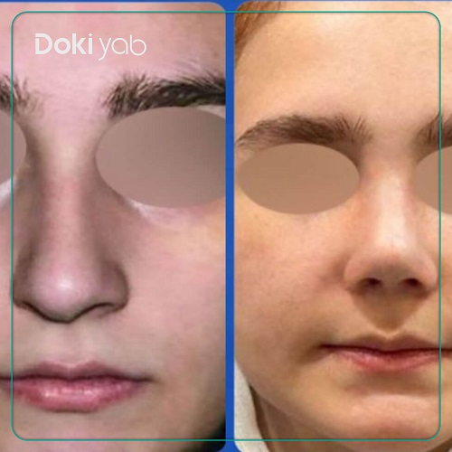 نمونه عمل بینی با دکتر عطاالله حیدری یکی از بهترین جراحان بینی ترمیمی در تهران