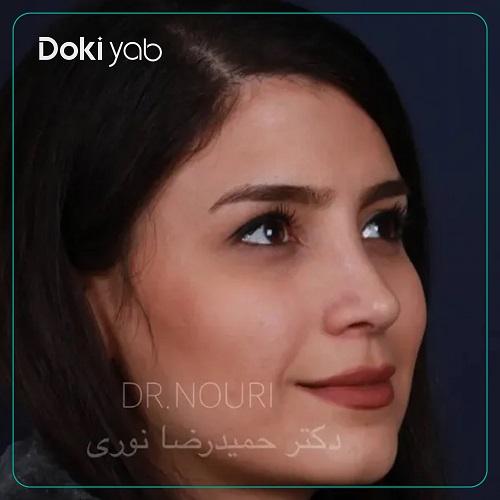نمونه جراحی بینی با دکتر حمیدرضا نوری در تهران