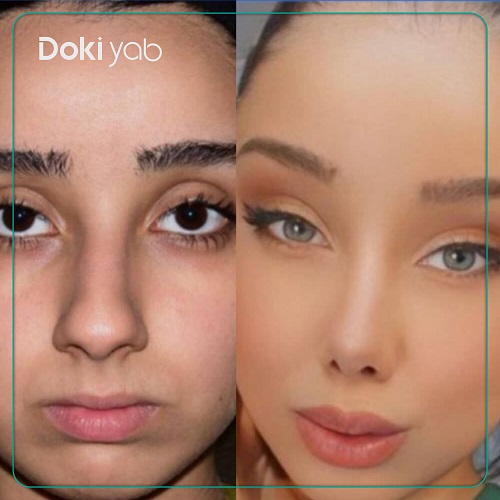 نمونه جراحی با دکتر عطاالله حیدری یکی از بهترین جراحان بینی ترمیمی در تهران