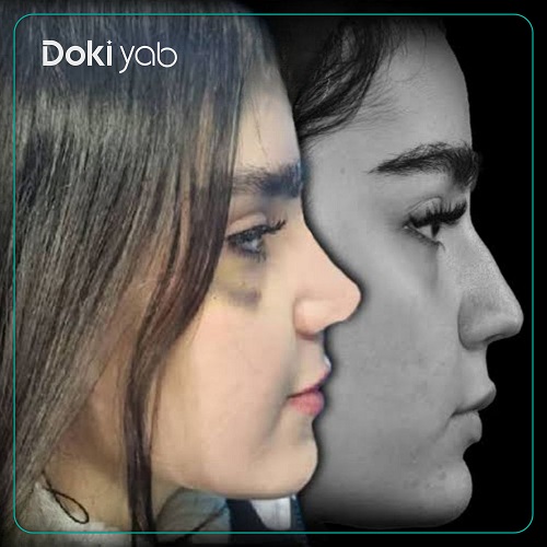 نمونه جراحی بینی با دکتر علی میقانی جراح بینی در تهران