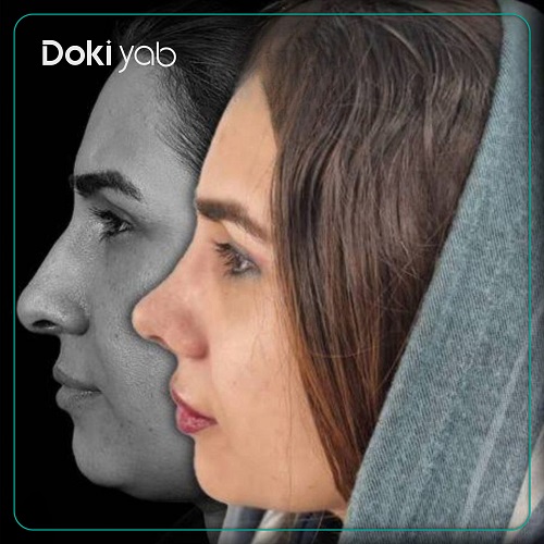 نمونه جراحی بینی با دکتر علی میقانی جراح بینی در تهران