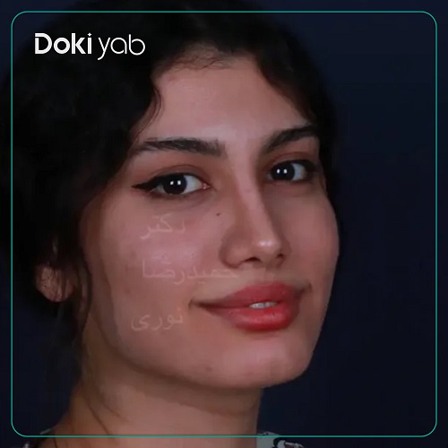 نمونه عمل بینی با دکتر حمیدرضا نوری در تهران