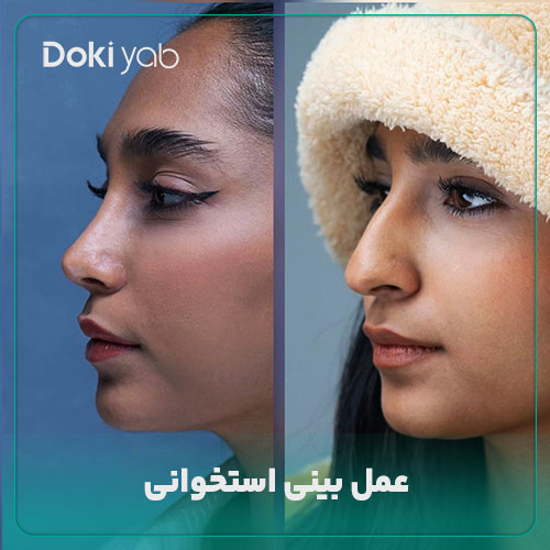 عمل بینی استخوانی در مجموعه دکی یاب