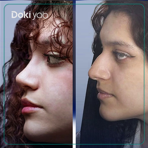 نمونه جراحی بینی استخوانی با دکی یاب