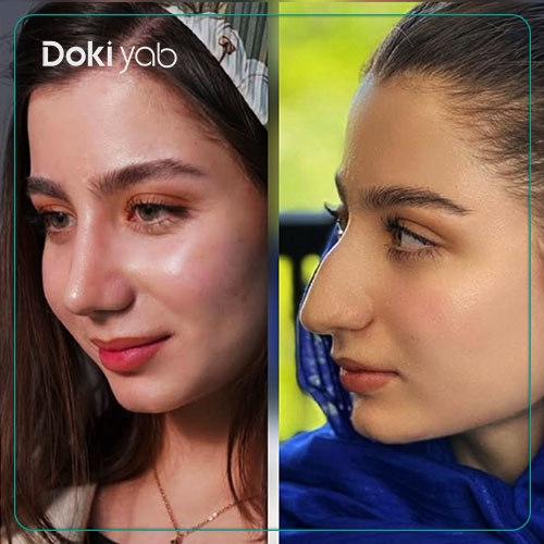 نمونه‌کار عمل بینی استخوانی با مشاوره دکی یاب