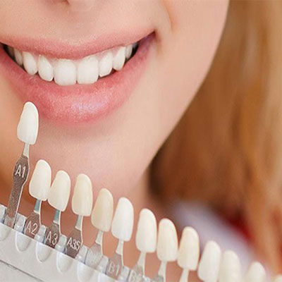 روش های جایگزین کامپوزیت دندان؛ مجموعه ی دکی یاب