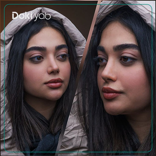 نمونه جراحی بینی با مجموعه دکی یاب با طراحی سه بعدی بینی قبل از عمل 