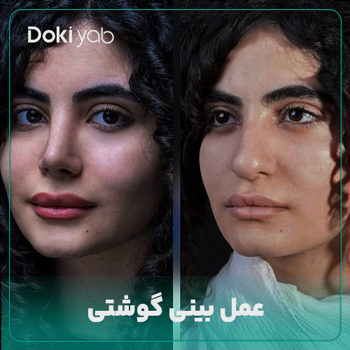 همه چیز درباره عمل بینی گوشتی در دکی یاب