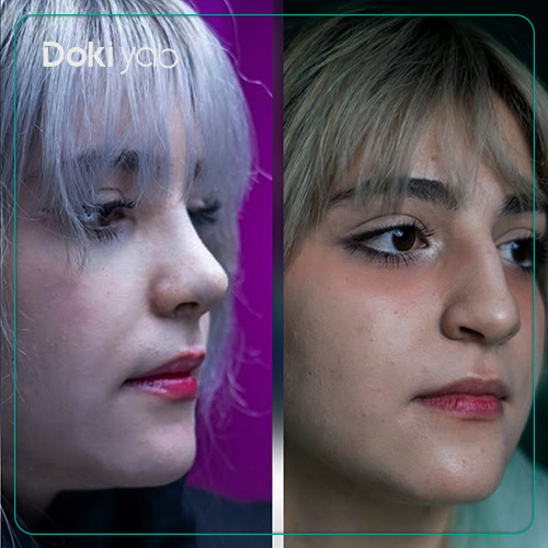 نمونه جراحی بینی گوشتی در دکی یاب