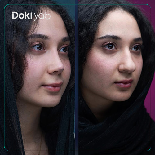 تصویر قبل و بعد عمل بینی گوشتی در دکی یاب
