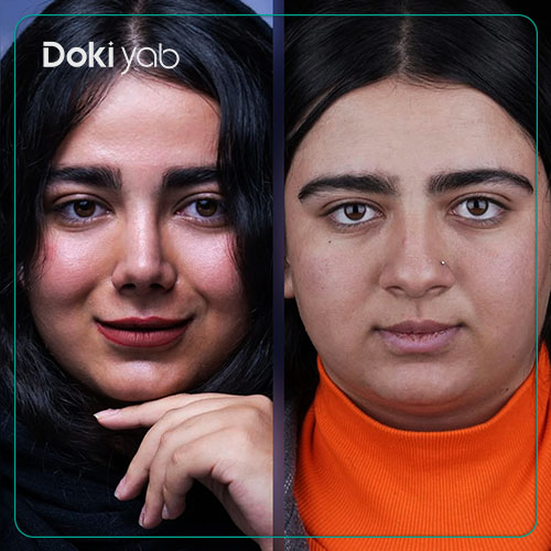 تصویر نمونه کار جراحی بینی گوشتی در دکی یاب