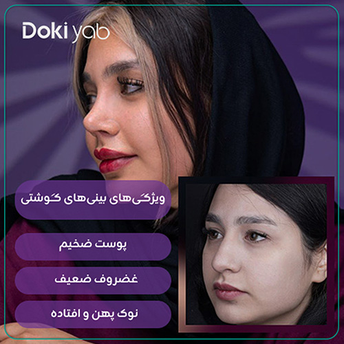 بررسی مشخصات بینی‌های گوشتی در دکی یاب
