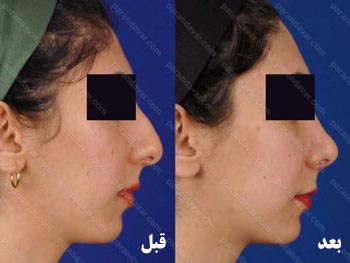 نمونه جراحی بینی توسط دکتر علی پرندآور در رشت، مجموعه دکی یاب