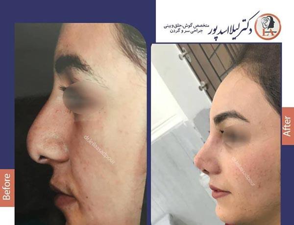 نمونه عمل بینی دکتر لیلااسدپور در شیراز؛ مجموعه دکی یاب