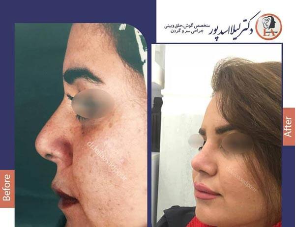 جراحی بینی دکتر لیلا اسدپور در شیراز؛ مجموعه دکی یاب