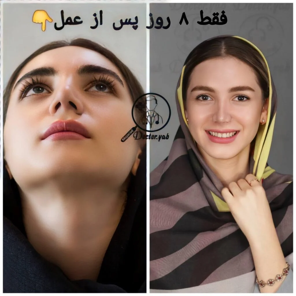 نمونه عمل بینی با مجموعه دکی یاب