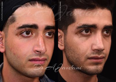 جراحی بینی ترمیمی با مجموعه دکی یاب در شیراز