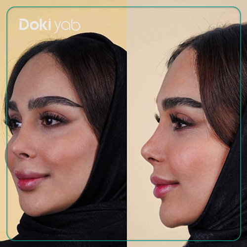 جراحی ترمیمی بینی؛ نمونه عمل بینی با مشاوره مجموعه دکی یاب